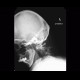 Subluxation in atlantoaxial joint in rheumatoid arthritis: X-ray - Plain radiograph